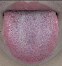 舌苔病症大全图解视频,揭秘舌象背后的健康秘密